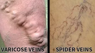 All about varicose veins | Usapang Pangkalusugan