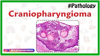 Craniopharyngioma: Causes, Pathology, Clinical manifestations, Diagnosis and Treatment