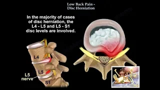 Low Back Pain , Disc Herniation - Everything You Need To Know - Dr. Nabil Ebraheim