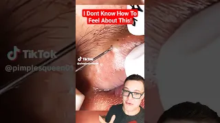 Crazy Bad BLACKHEAD REMOVAL - I Dont Know What To Think #shorts