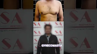 Real Patient Real Results Gynecomastia Before And After