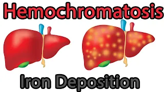 Hemochromatosis Easy explained; symptoms, causes, treatment, prognosis