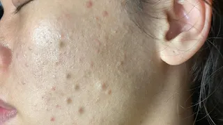 Huong Da Nang Acne Treatment #267