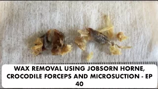 EAR WAX REMOVAL USING JOBSORN HORNE, CROCODILE FORCEPS AND MICROSUCTION - EP 40