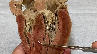 Heart Valve Function