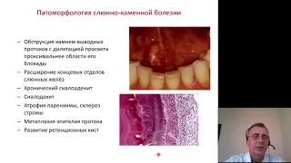 Патанатомия. Заболевания слюнных желез