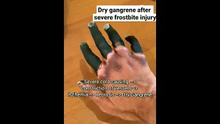 Dry Gangrene