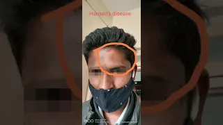 Leprosy or Hansen's disease