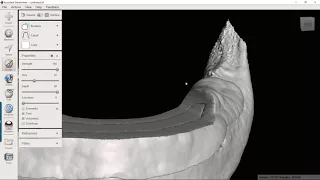 Creating a Bone Reduction Guide and Surgical Guide with Blue Sky Plan