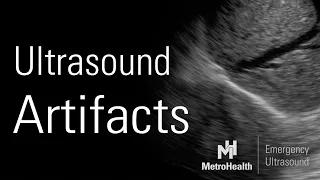 Ultrasound Artifacts