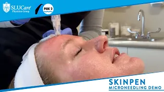 Skinpen Microneedling: How it Works & Demonstration - SLUCare MedSpa