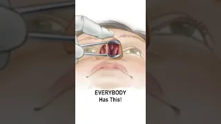 Nasal Obstruction Due to Turbinate Hypertrophy #shorts @fauquierent