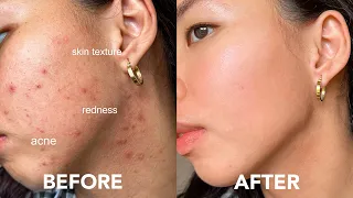 EASY WAY TO GET RID OF ACNE (tiny bumps, redness, texture, acne scars)