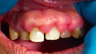 SEVERELY Swollen Gums - A Side Effect of Which Medication?