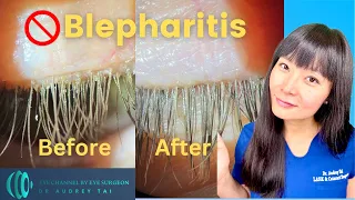Best Blepharitis Treatments at Home | Simple & Effective | Step by Step Guide |Eye Surgeon Explains
