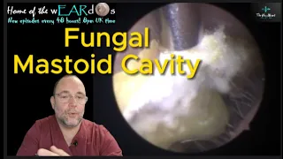 FUNGAL MASTOID CAVITY 237 #ear #earwax #earwaxremoval #earcleaning #fungal  #asmr #fyp #mastoid