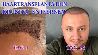Haartransplantation KRUSTEN ENTFERNEN | Erfahrung | Kniescheibe