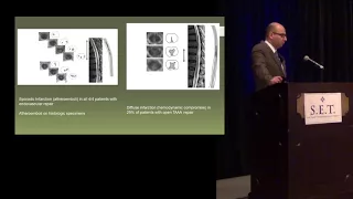 Spinal Cord Ischemia with Endovascular Treatment of Thoracoabdominal Aortic Aneurysms