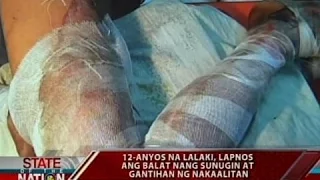 SONA: 12-anyos na lalaki, lapnos ang balat nang sunugin at gantihan ng nakaalitan