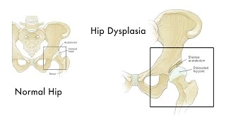 Developmental dysplasia of the hip - Orthopedic Center - Boston Children's Hospital