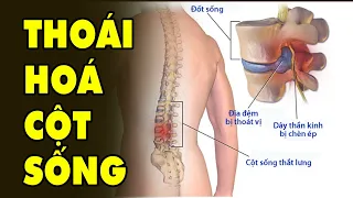 Tuyệt Chiêu Mẹo Hay Chữa Thoái Hoá Cột Sống - Thoát Vị Đĩa Đệm - Đau Lưng Ê Buốt | HYT3