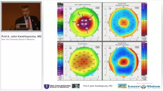 Early Keratoconus diagnosis with Scheimpflug tomography and epithelial mapping