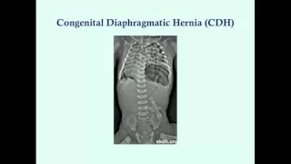 Newborn Gastrointestinal Disorders (Part 2) - CRASH! Medical Review Series