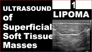 Ultrasound of superficial soft tissue masses