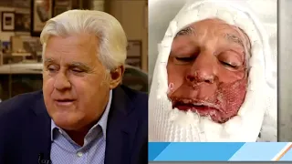 Jay Leno Shares Unseen Photos of Horrific BURN Injuries