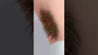 ASMR Armpit Hair and Pustule Removal: Removing Hair and Tick from Infected Armpit | Relaxing ASMR