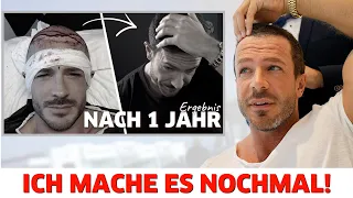 Meine Haartransplantation | Ich mache es noch einmal!