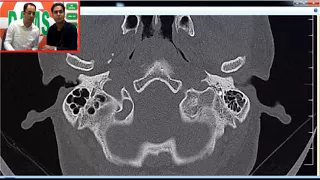 Temporal Bone CT | Radioclinical Perspective