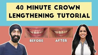 40 Minutes Crown Lengthening Tutorial with Reena Wadia - PDP079