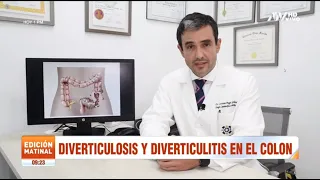 Diverticulosis y diverticulitis en el colon