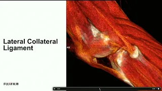 Webinar: Ultrasound Evaluation of the Medial and Lateral Knee