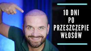 Przeszczep włosów w Turcji - relacja 10 dni po zabiegu.