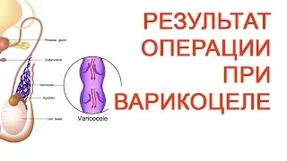 Результат операции при варикоцеле / Доктор Черепанов