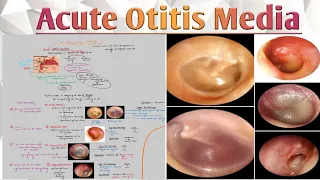Acute Otitis Media (Causes, Pathophysiology, Signs & symptoms, Treatment)