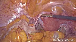 Surgical Anatomy of Pelvis as Developed in Radical Hysterectomy
