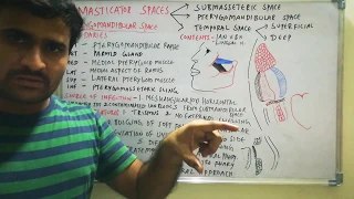 Pterygomandibular space infection