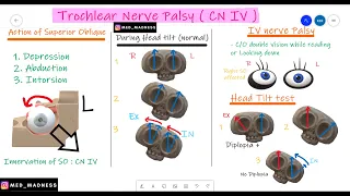 Trochlear Nerve Palsy | CN IV | Why Head Tilt ? | Action of Superior Oblique| Med Madness