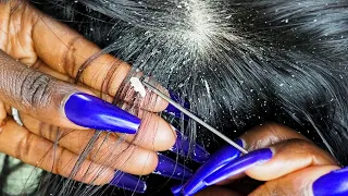 {ASMR} Super Intense 🤯 Scalp Scratching & PICKING | ALLZOOMED | layered sounds