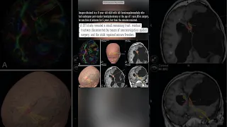 MRI guided laser induced thermal therapy (MRgLITT) - scan medical radiology course sound brain Hindi