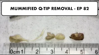 MUMMIFIED Q-TIP AND EAR WAX REMOVAL - EP 82