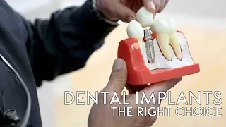 A Dental implant is hands down the best option available for replacing a missing tooth