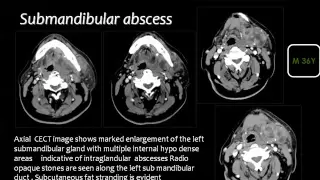 Imaging of head and neck infection II  Prof Dr  Mamdouh Mahfouz In Arabic