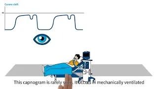 MedEd capnography byte 17: Curare cleft