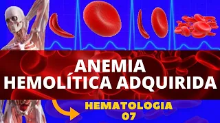 ANEMIA HEMOLÍTICA ADQUIRIDA - HEMATOLOGIA (ESTUDO DAS ANEMIAS)
