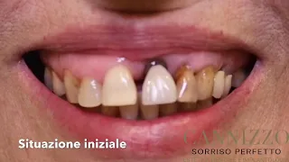 Quando L’ Implantologia dentale