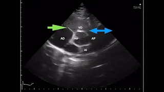 Ecocardiografía básica Tema 1: Planos ecocardiográficos